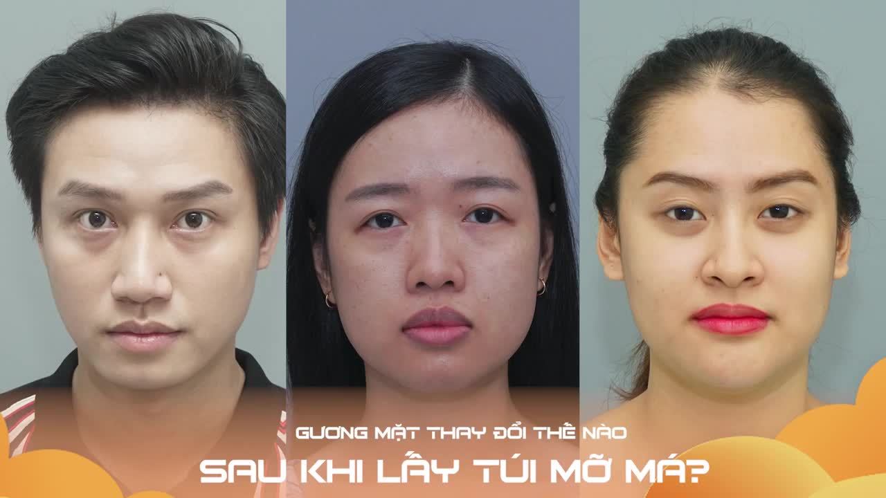 LẤY TÚI MỠ MÁ GP THON GỌN KHUÔN MẶT CHO NGƯỜI CÓ MÁ PHÍNH, CHẢY XỆ