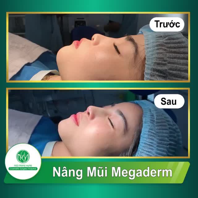 CẬN CẢNH SỰ THAY ĐỔI TRƯỚC VÀ SAU NÂNG MŨI MEGADERM.