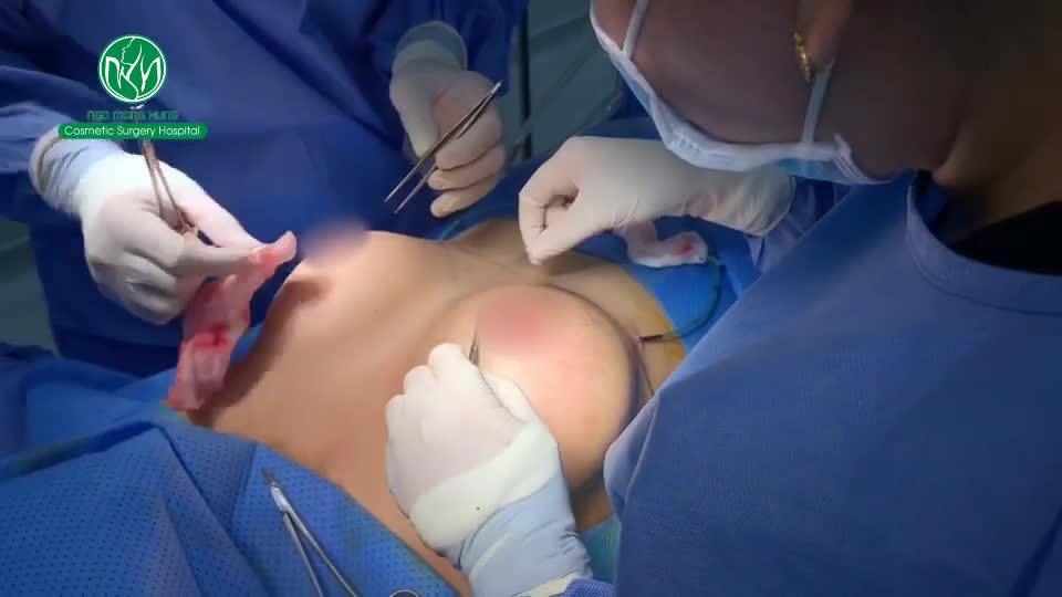 CA NÂNG NGỰC ĐƯỜNG QUẦNG SẮP HOÀN TẤT