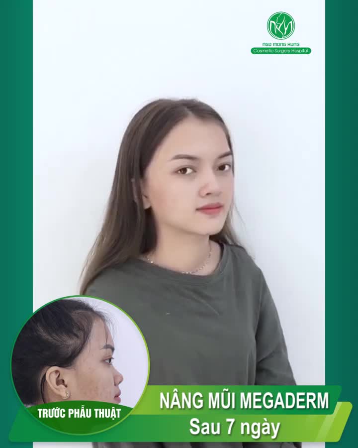CẬN CẢNH DÁNG MŨI SAU CẮT CHỈ TẠI BỆNH VIỆN