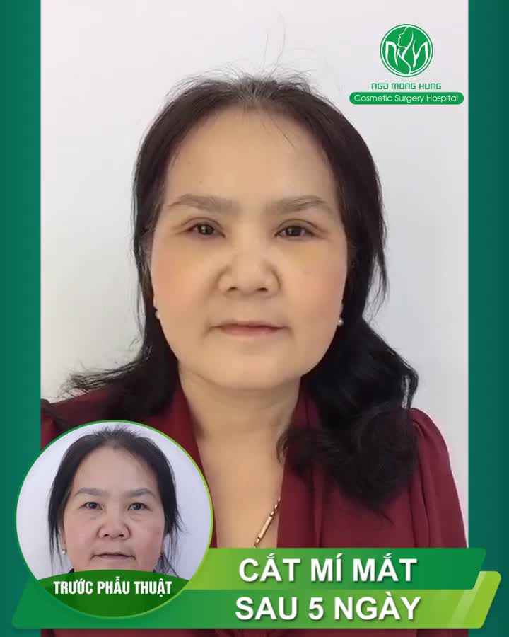Khách được 5 ngày cắt mí trên mí dưới