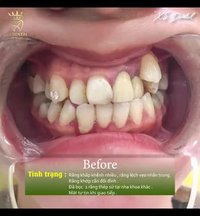 Cảm nhận thực thế của khách hàng khi hoàn thành xong ca thẩm mỹ 16 răng sứ Ceramill cao cấp ..