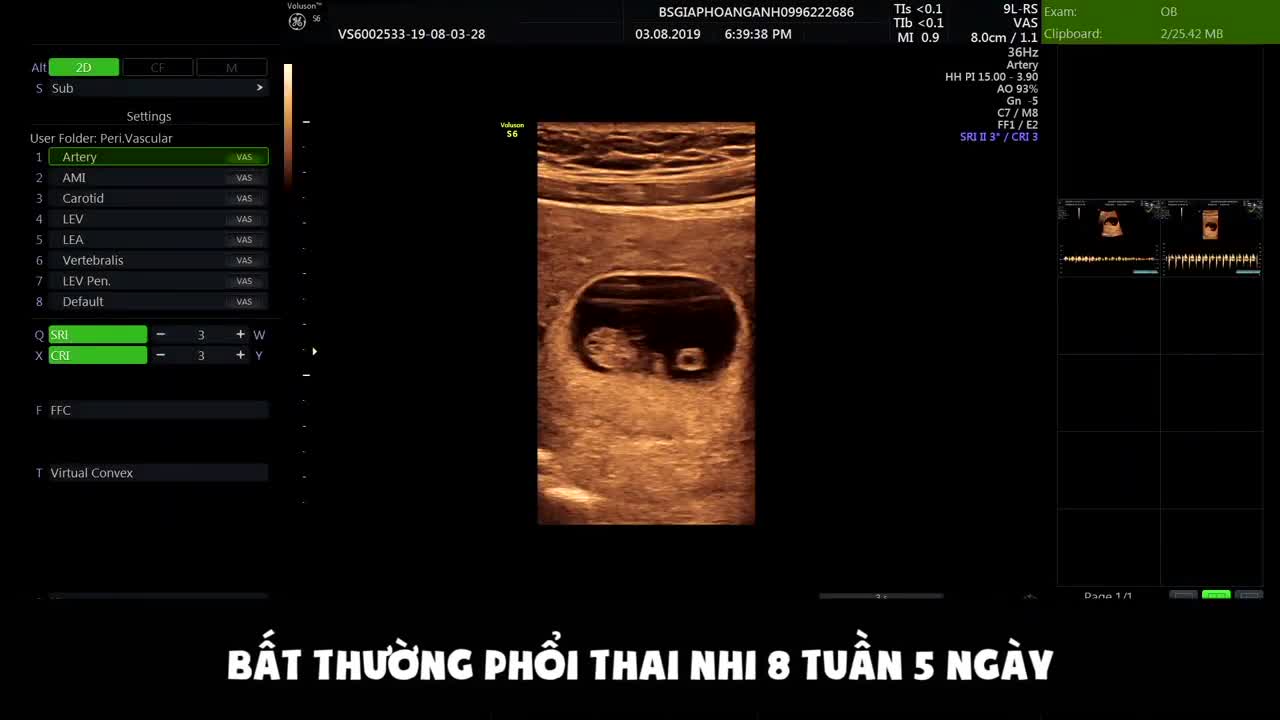 Bất thường phổi của thai 8 tuần 5 ngày - Siêu âm thai Hoàng Anh