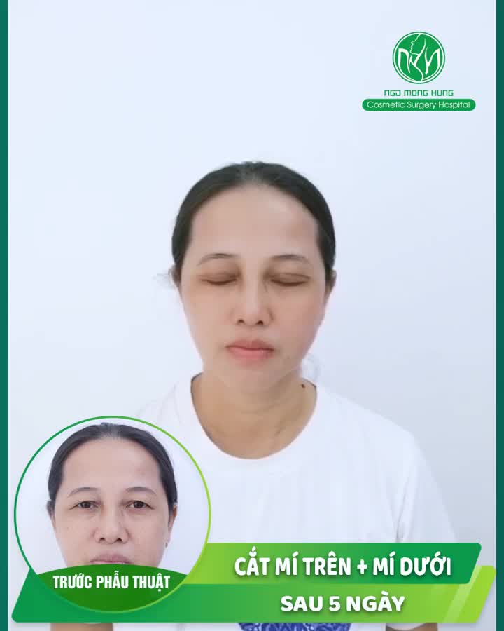 Combo: mí trên + mí dưới