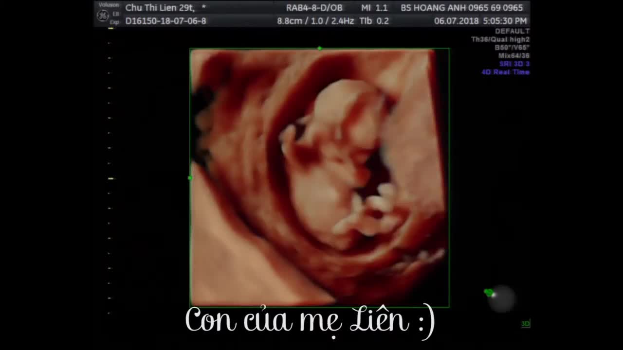 Con của mẹ Chu Thị Liên 29T 6/7/2018 - Siêu âm thai - Bs Giáp Hoàng Anh - Bắc Giang
