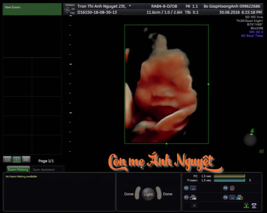 Con của mẹ Trần Thị Ánh Nguyệt 30/8/2018 Siêu âm thai Bs Giáp Hoàng Anh