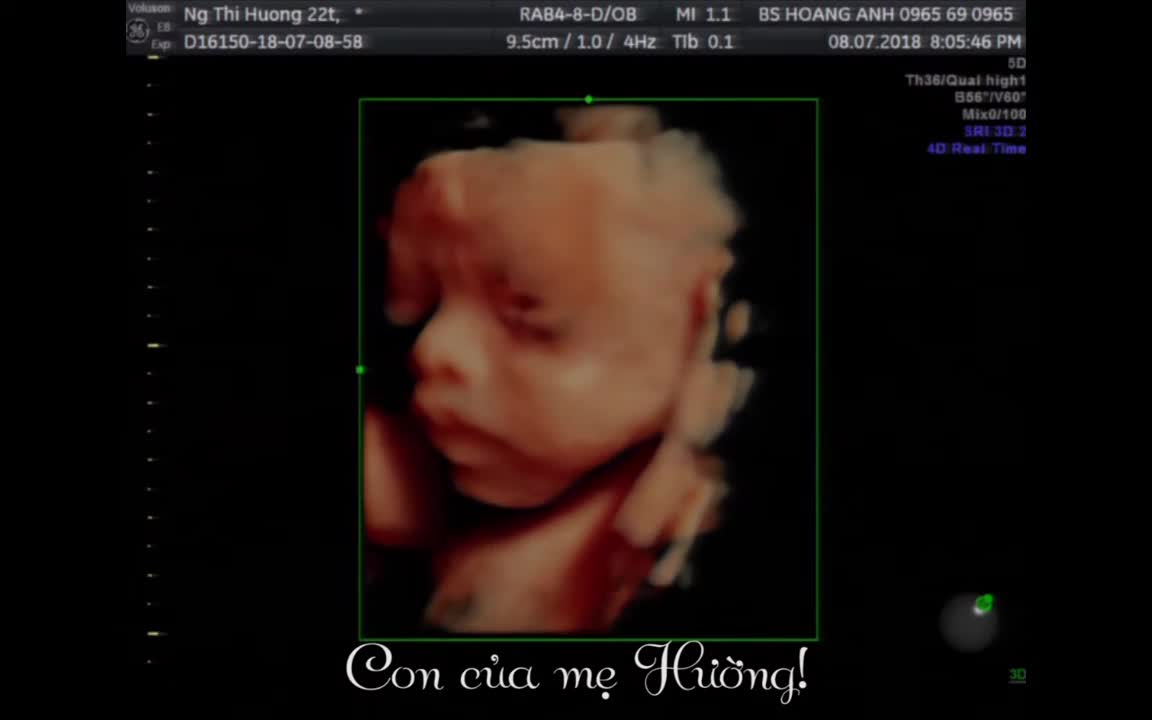 Con mẹ Nguyễn Thị Hường 22T 7/8/2018 Siêu âm thai Bs Giáp Hoàng Anh
