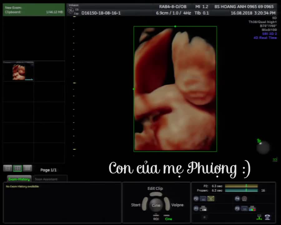 Con mẹ Phượng 16/8/2018 - Siêu âm thai - Bác sĩ Giáp Hoàng Anh