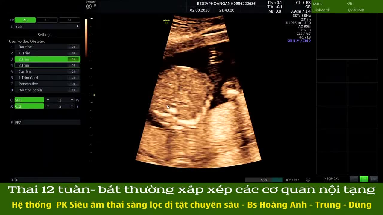 Hội chứng đồng dạng thai 12 tuần hệ thống PK siêu âm thai sàng lọc dị tật chuyên sâu!