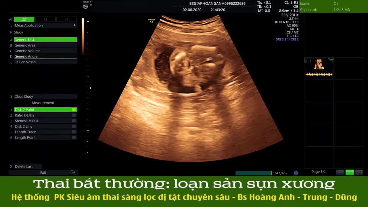 Loạn sản sụn xương - Hệ thống PK siêu âm thai BS Hoàng Anh - Trung - Dũng