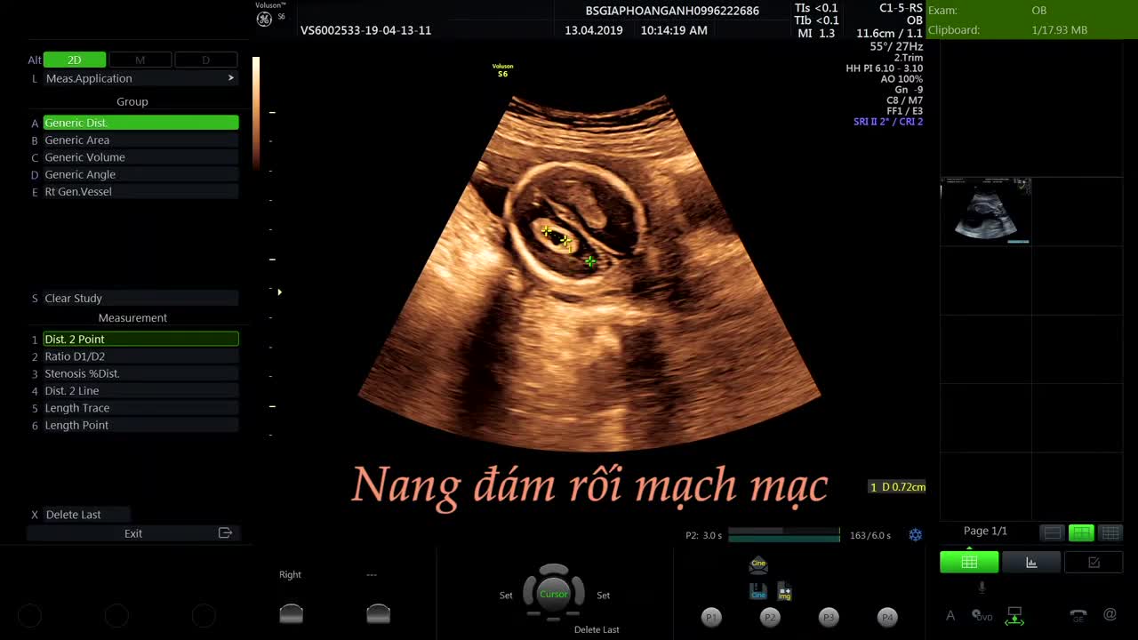 Nang đám rối mạch mạc thai nhi - Hệ thống phòng khám siêu âm thai - Bs Giáp Hoàng Anh