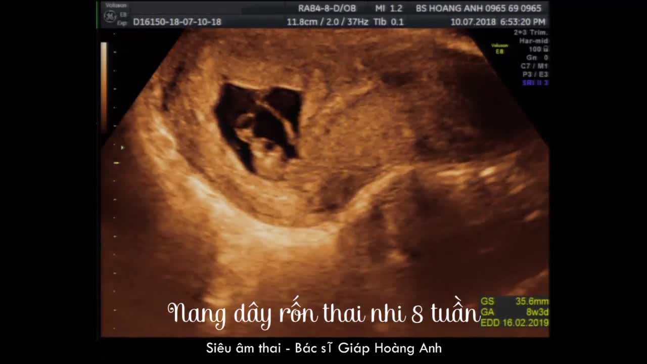 Nang dấy rốn ở thai nhi 8 tuần - Siêu âm thai - Bs Giáp Hoàng Anh
