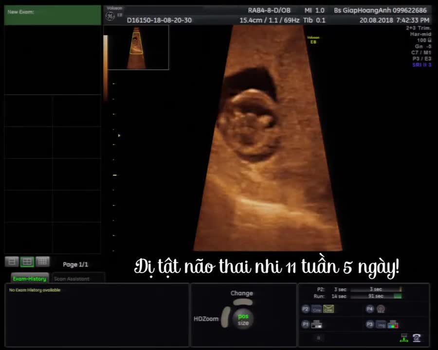 Não trước không phân chia ở thai 11 tuần 5 ngày - Siêu âm thai