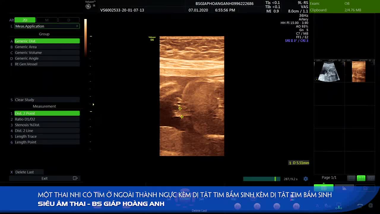 Pentalogy of Cantrell - Thai nhi có tim nằm ở ngoài lồng ngực - Hệ Thống PK siêu âm thai BS G.H.A