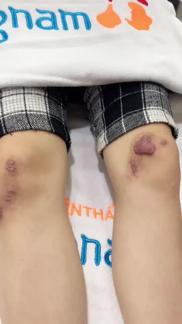 Sẹo lồi to do tai nạn nên điều trị thế nào để hiệu quả?