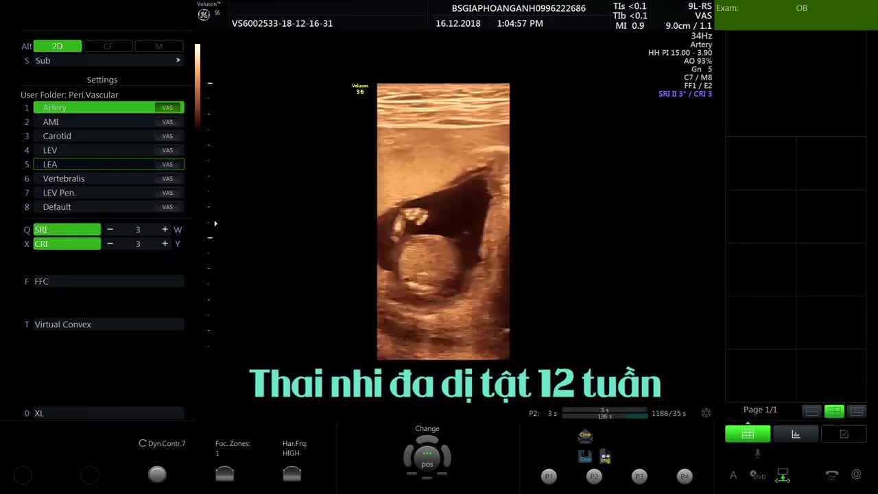Siêu âm thai 12 tuần! Mẹ bầu nhớ đi nhé - Thai 12 tuần đa dị tật - BS siêu âm Giáp Hoàng Anh