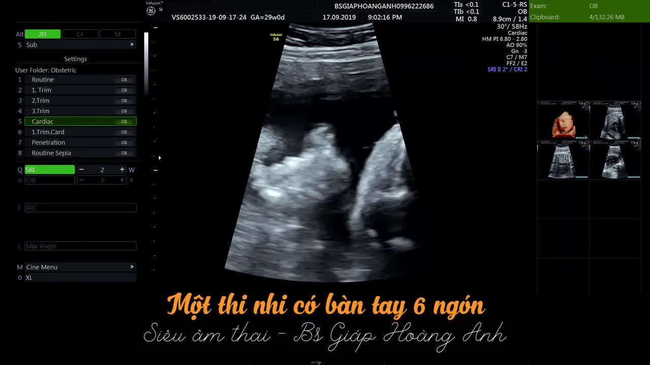 Siêu âm thai - Bàn tay thai nhi có 6 ngón tay - không thể chủ quan!