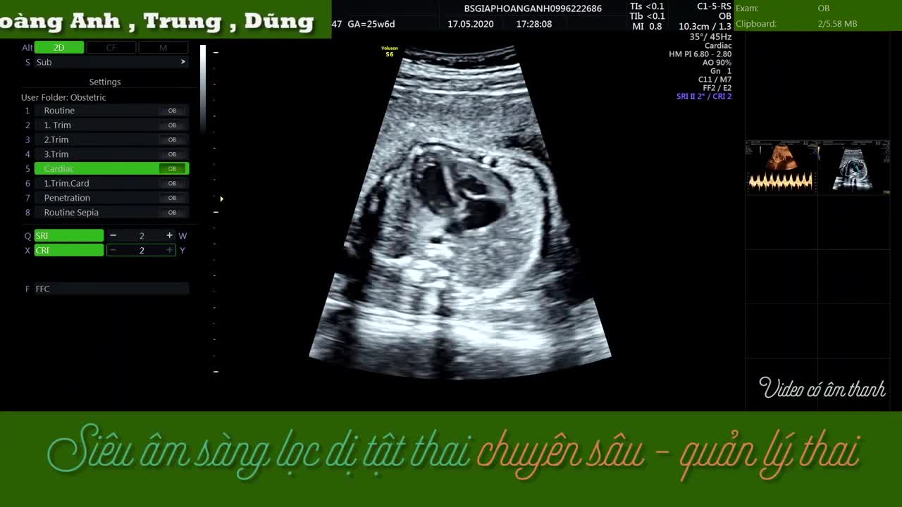 siêu âm thai​ bất thường van 3 là, van động mạch phổi tim thai