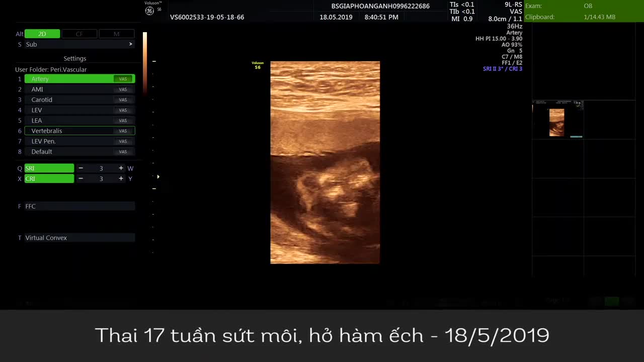 Sứt môi hở hàm ở thai nhi 17 tuần - Hệ thống Siêu âm thai Bs Giáp Hoàng Anh