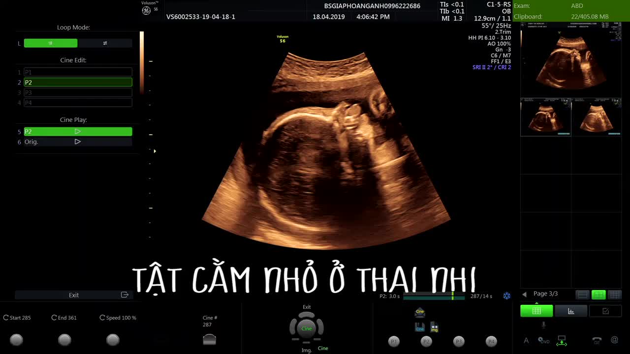 Tật cằm nhỏ ở một thai nhi đột biến nhiễm sắc thể - Do bác sĩ trong hệ thống phòng khám phát hiện.