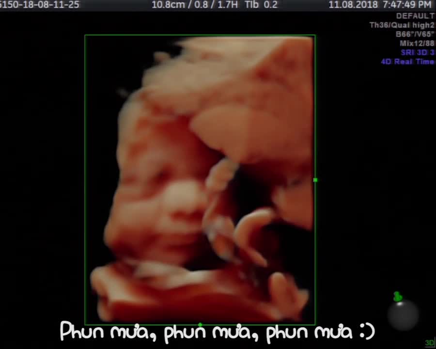 Thai nhi "phun mưa" trong bụng mẹ - Siêu âm thai - Bác sĩ Giáp Hoàng Anh
