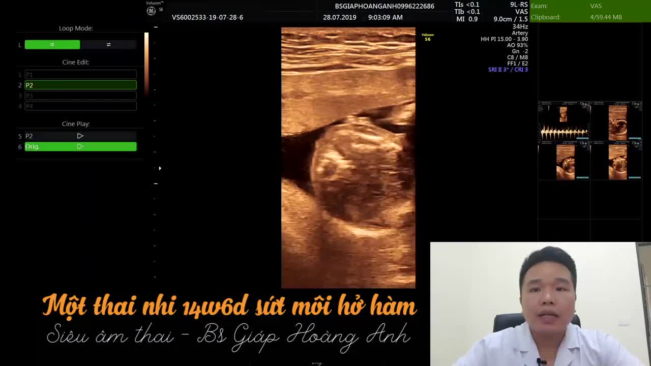 Thai nhi bị sứt môi hở hàm ếch 14w - Siêu âm thai Hoàng Anh Bắc Giang