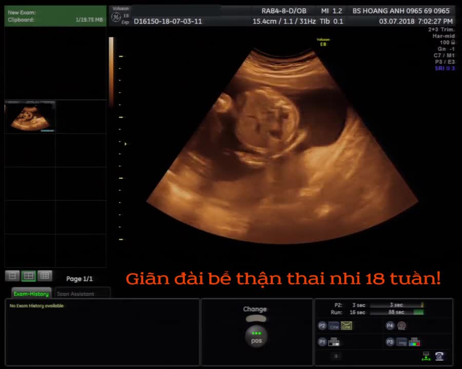 Thai nhi giãn đài bể thận - SIêu âm thai - Bs Giáp Hoàng Anh