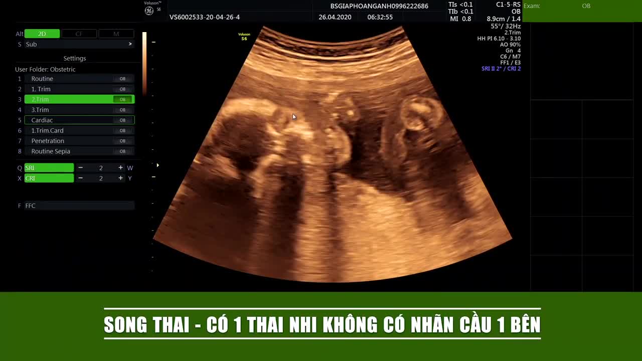Thai nhi không có mắt một bên, không có nhãn cầu 1 bên mà chỉ có da mi.