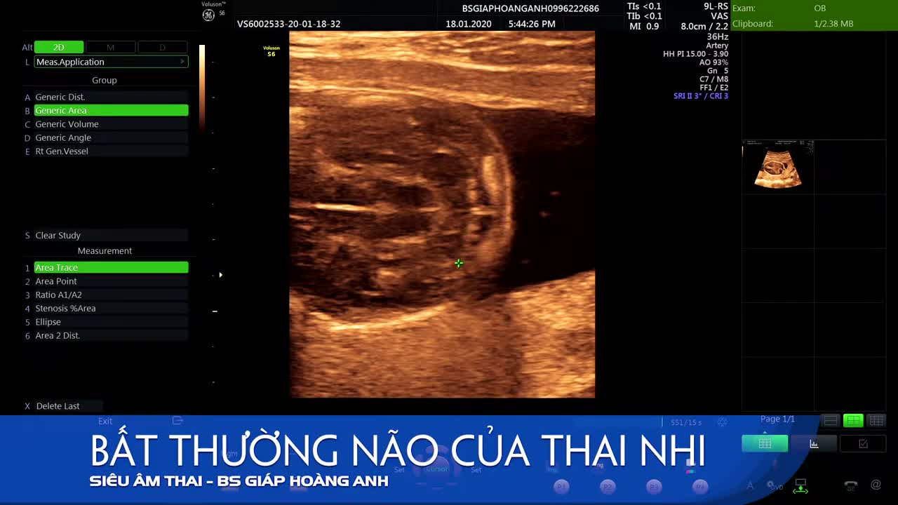Thoát vị não, màng não ở thai nhi - Một bất thường hiếm gặp - Hệ thống PK siêu âm thai Bs G.H.A