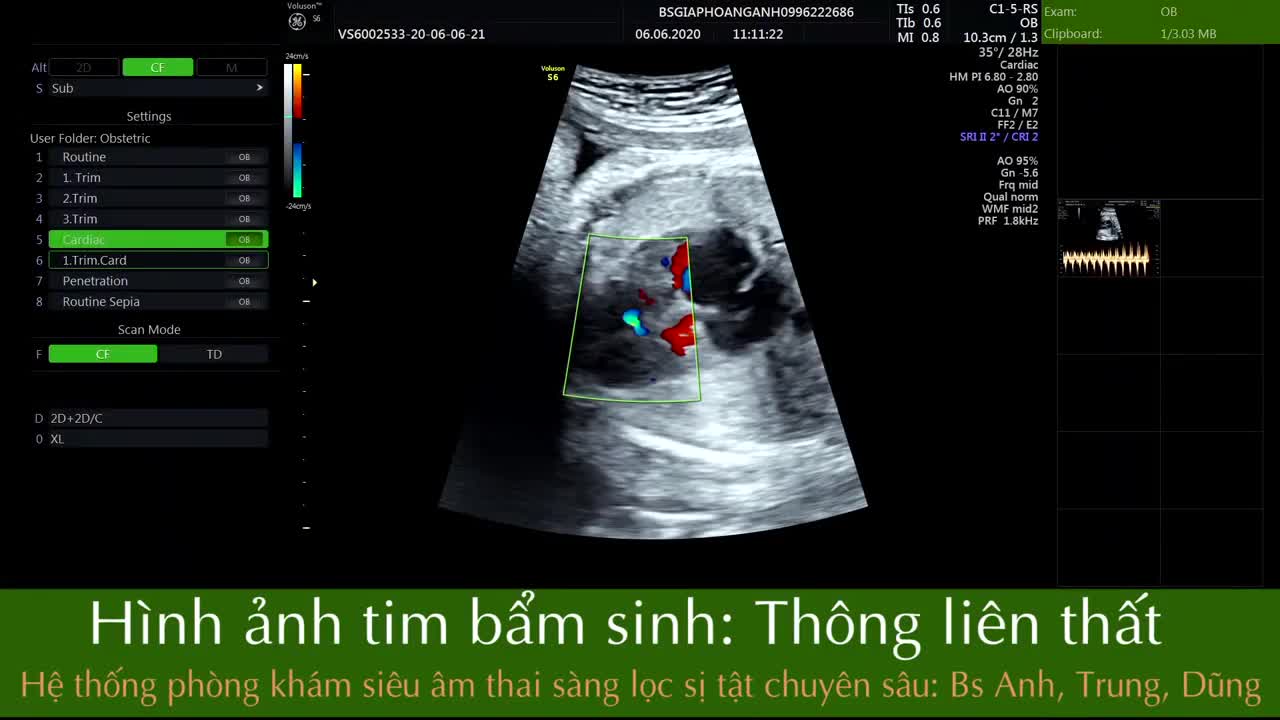 Thông liên thất tim thai - Hệ thống phòng khám siêu âm thai sàng lọc dị tật chuyên sâu.