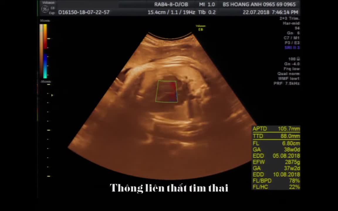 Thông liên thất tim thai - Siêu âm thai - Bs Giáp Hoàng Anh
