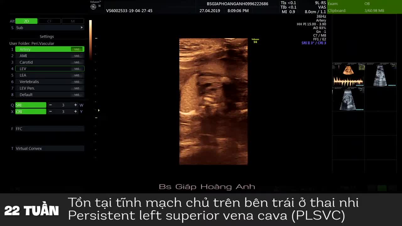 Tồn tại tĩnh mạch chủ trên trái ở thai nhi - Bác sĩ trong hệ thống PK BS Giáp Hoàng Anh phát hiện.