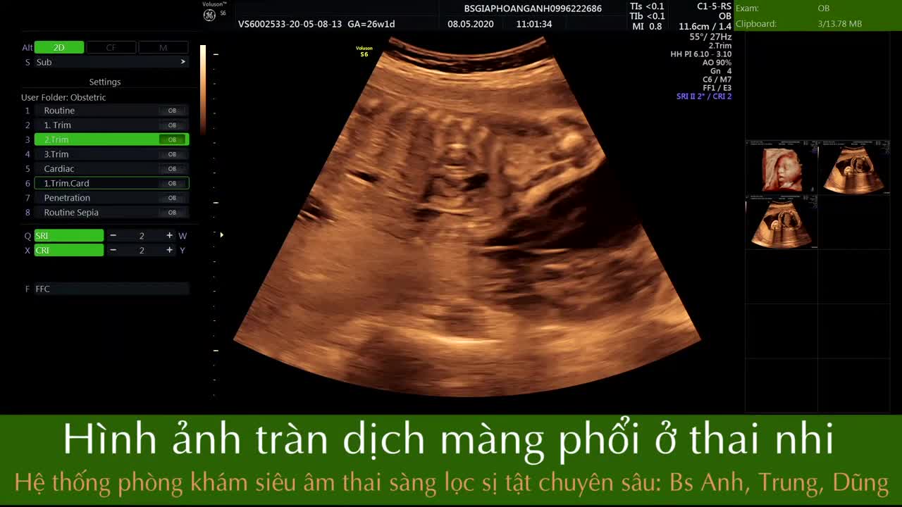 Tràn dịch màng phổi ở thai nhi hệ thống phòng khám siêu âm thai sàng lọc dị tật chuyên sâu