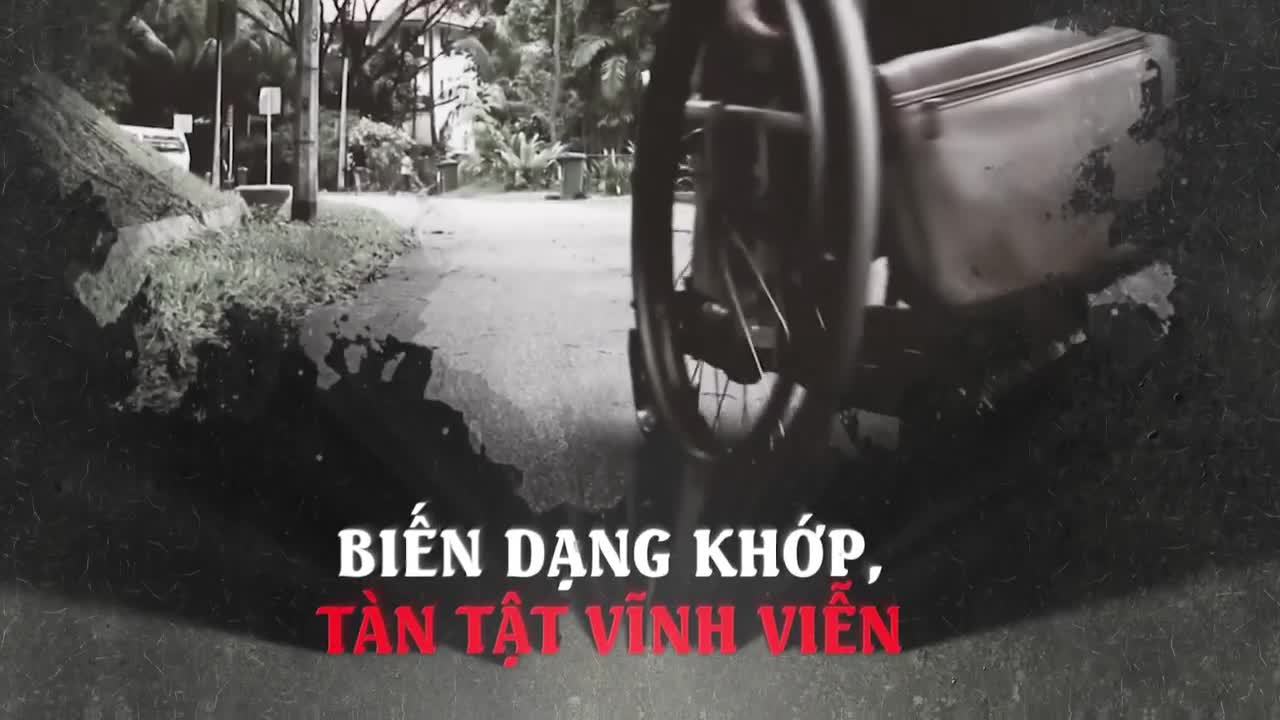 Bệnh cơ xương khớp Nguyên nhân hàng đầu gây tàn phế