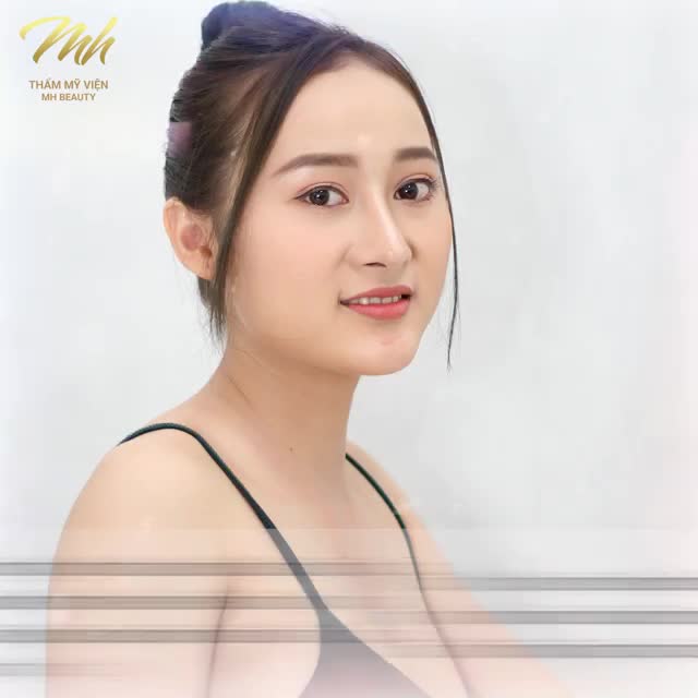 FEEDBACK KHÁCH HÀNG SAU KHI NÂNG MŨI BÁC SĨ MÃ HIỆP