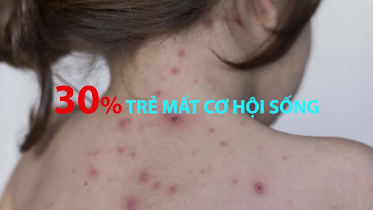 GIỚI THIỆU VẮC XIN MỚI PHÒNG BỆNH THỦY ĐẬU - BÍ QUYẾT PHÒNG BỆNH MÙA ĐÔNG XUÂN CHO TRẺ EM VÀ NGƯỜI LỚN
