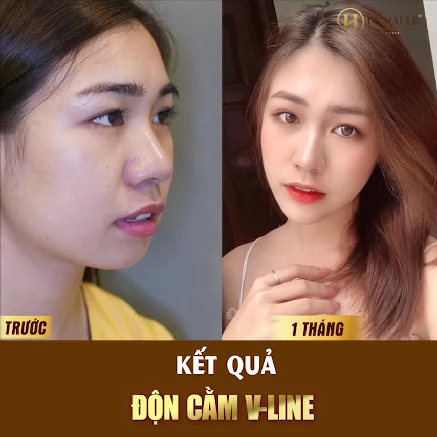KẾT QUẢ SAU 8 THÁNG ĐỘN CẰM V-LINE - TRỞ THÀNH PHIÊN BẢN ĐẸP NHẤT CỦA CHÍNH MÌNH