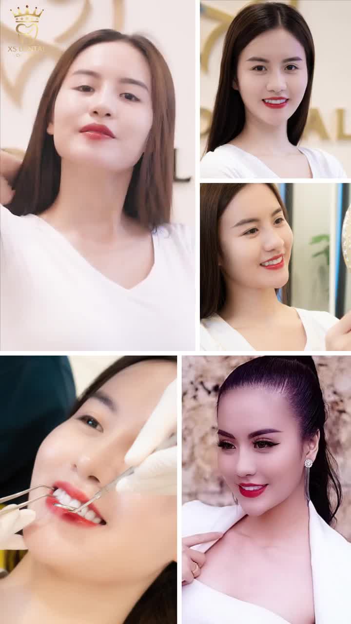 Khách Hàng trở lại chăm sóc răng sau một thời gian hoàn thiện nụ cười 20 răng sứ