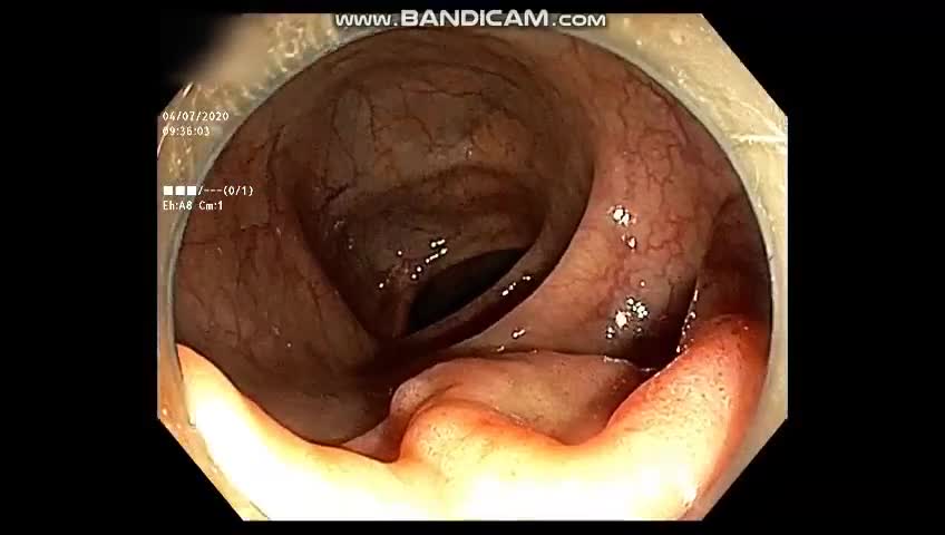 NỘI SOI PHÁT HIỆN POLYP CHIẾM NỬA CHU VI LÒNG ĐẠI TRÀNG, CÓ DẤU HIỆU LOẠN SẢN