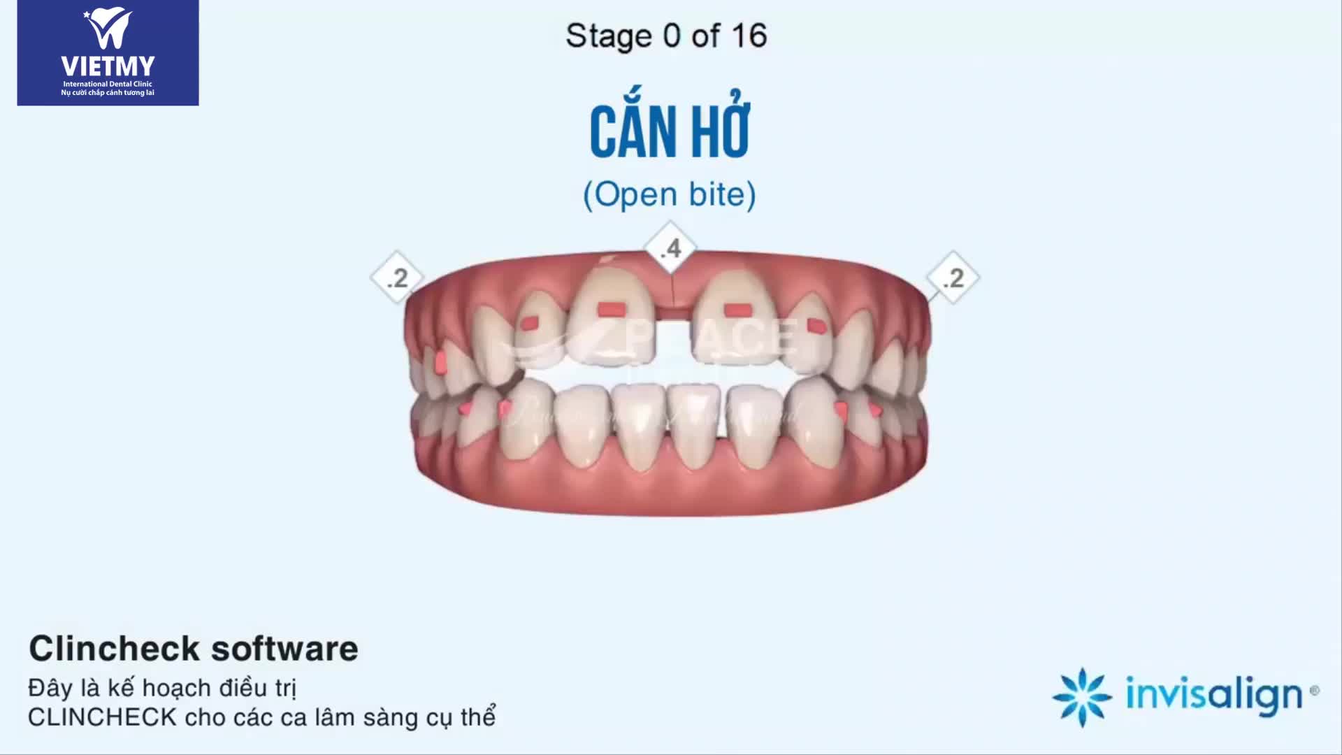 RĂNG CỦA BẠN SẼ DI CHUYỂN NHƯ THẾ NÀO KHI NIỀNG RĂNG INVISALIGN