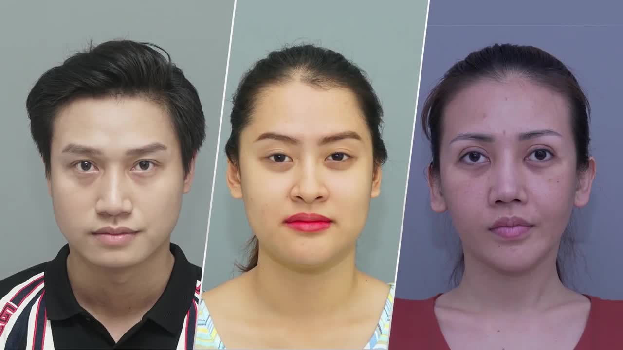 SỰ KHÁC BIỆT TRƯỚC VÀ SAU LẤY TÚI MỠ MÁ
