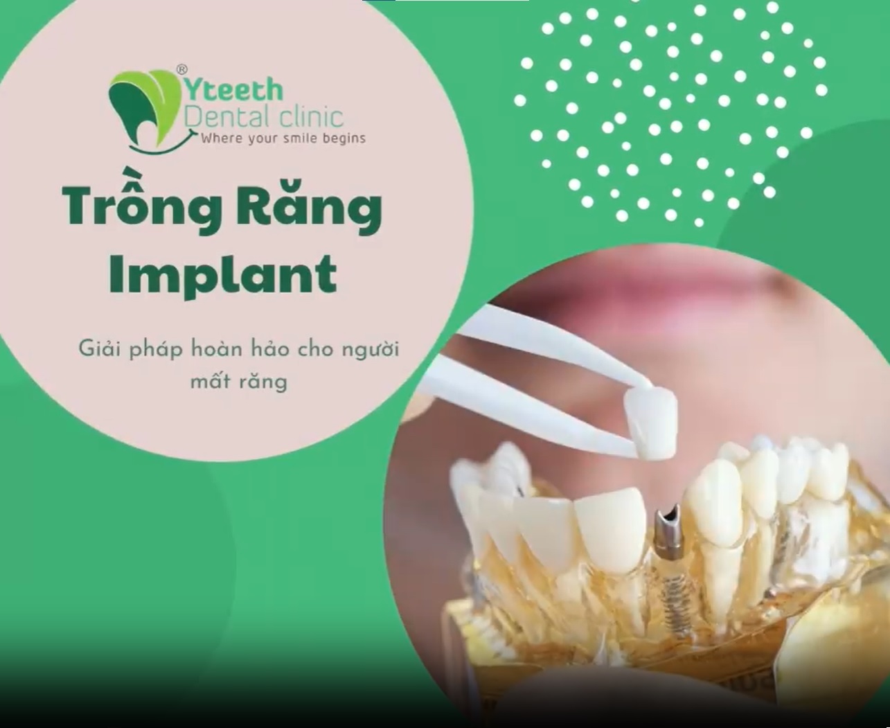 TRỒNG RĂNG IMPLANT - GIẢI PHÁP HOÀN HẢO CHO NGƯỜI MẤT RĂNG