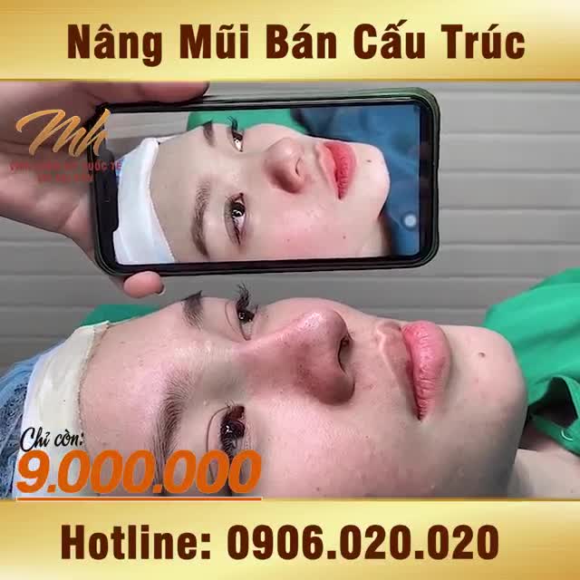 ƯU ĐÃI CHỈ 9TR!! Sở hữu mũi thon gọn, chuẩn đẹp, góc nghiêng thần thánh tha hồ selfie!