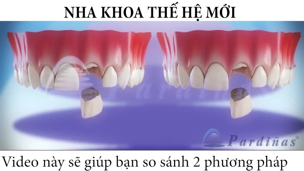 BẮC CẦU RĂNG SỨ hay chọn CẤY GHÉP IMPLANT? Giảp pháp nào cho người mất răng