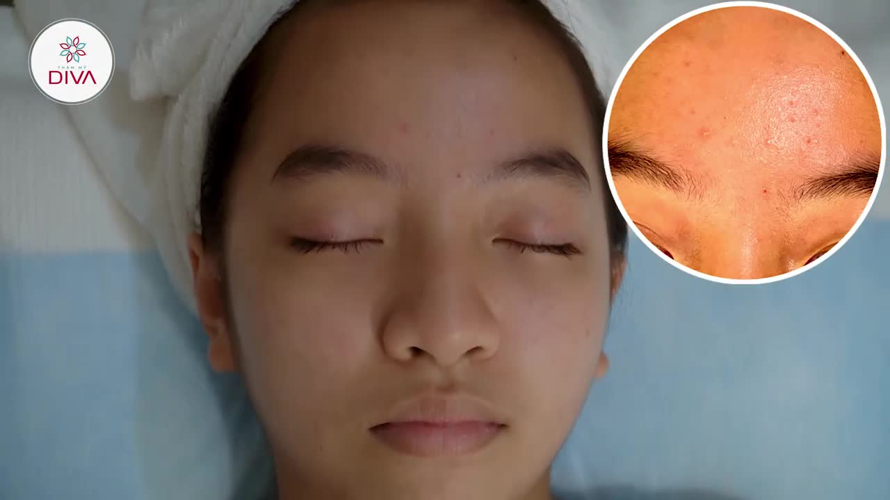 BÍ KÍP ĐẨY LÙI MỤN TRƯỚC CHU KÌ “ĐÈN ĐỎ”
