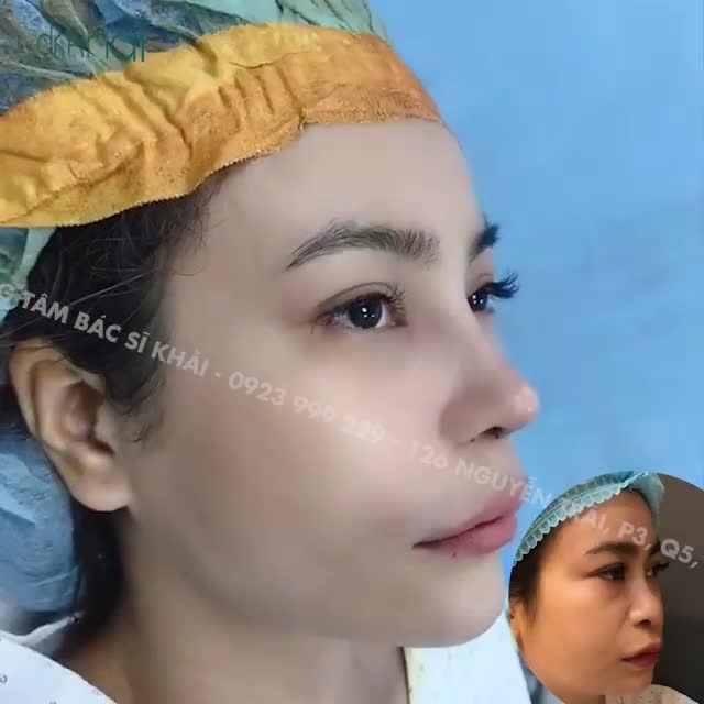 Em gái lột xác nhờ combo MŨI CẰM