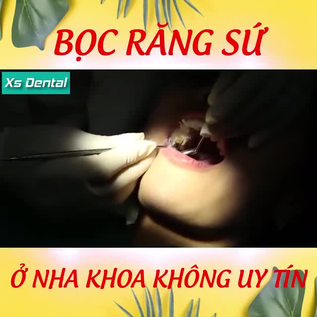 HIỂM HỌA KHÔN LƯỜNG KHI CHỌN BỌC RĂNG SỨ SAI CÁCH