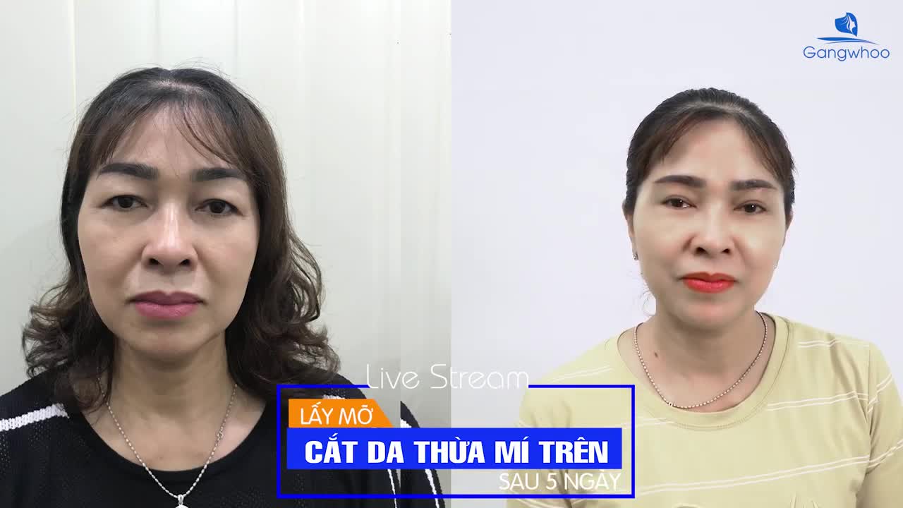 LẤY MỠ CẮT DA THỪA MÍ TRÊN SAU 5 NGÀY CÙNG KHÁCH HÀNG CỦA DR. PARK