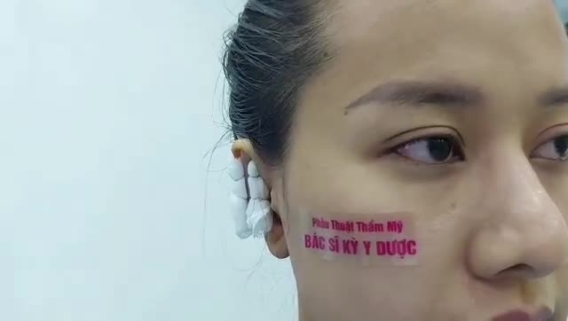 PHẪU THUẬT CHỈNH HÌNH TAI VỂNH KẾT HỢP XỬ LÝ SỤN TAI TẠO HÌNH VÀNH TAI ĐƯA VỀ CẤU TRÚC NGUYÊN BẢN