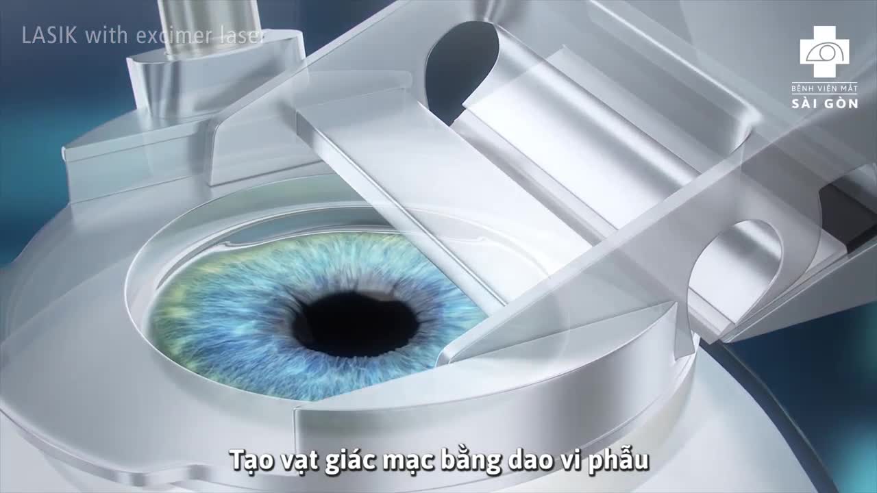 PHƯƠNG PHÁP XÓA CẬN LASIK